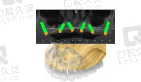 上海曙康口腔做半口种植牙设计
