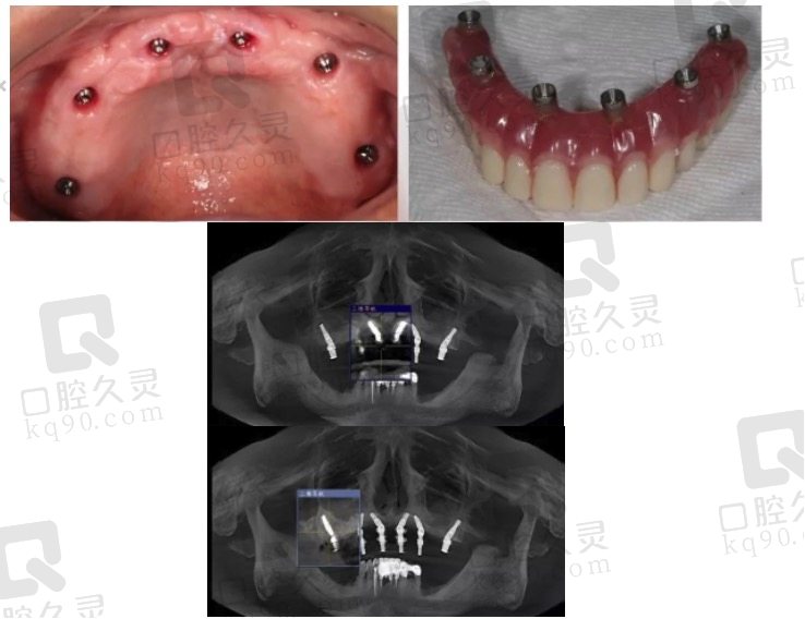 上海曙康口腔做半口种植牙使用体验