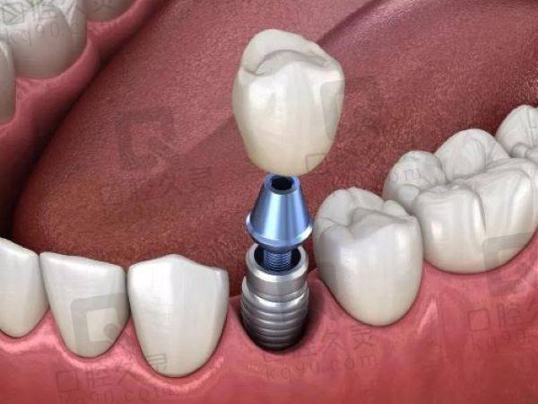 莆田君特口腔种植牙怎么样