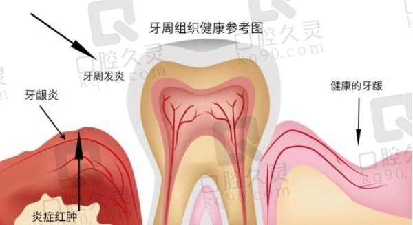 牙周炎晚期四大特征