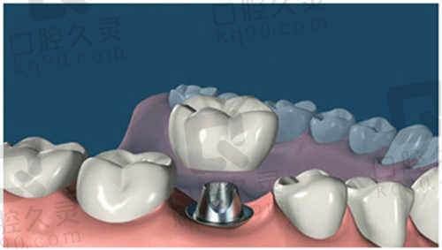 乌鲁木齐牙博士口腔种植牙价格表