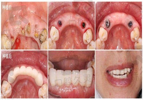 我在重庆城口众合口腔医院做种植牙的术后恢 复情况如何?
