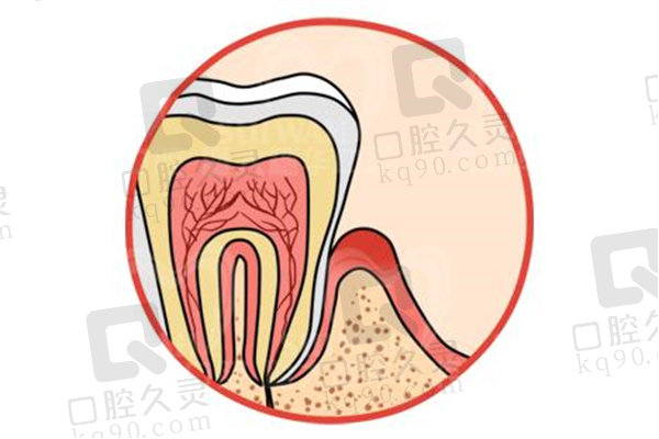 牙髓炎的症状有哪些