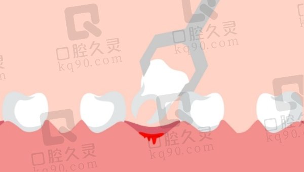 青岛青大口腔医院拔牙注意事项