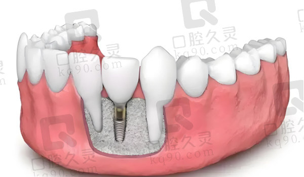 种植牙种植