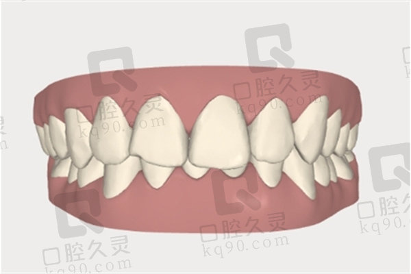  深覆合有必要矫正吗