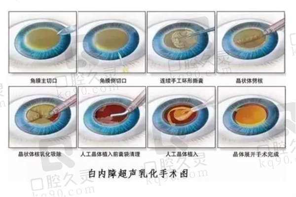 白内障手术怎么做的全过程