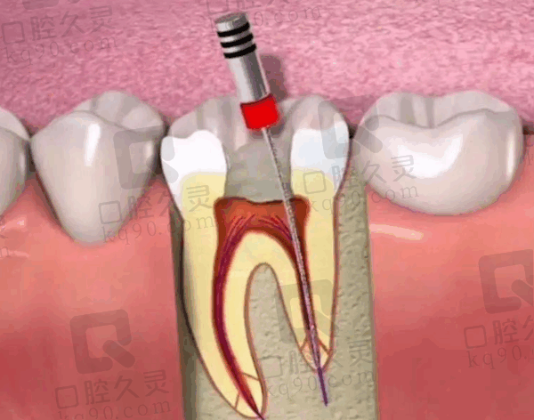 许昌植得口腔后牙根管治疗怎么样