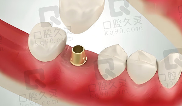 种植牙种植