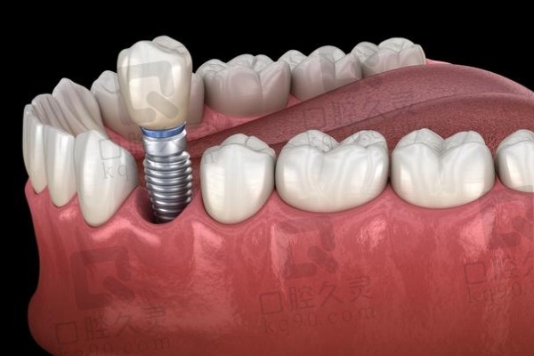 喀什福宏林口腔医院种植牙价格