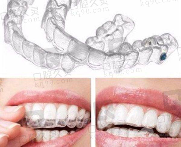 哈尔滨优诺口腔医院隐适美隐形矫正怎么样