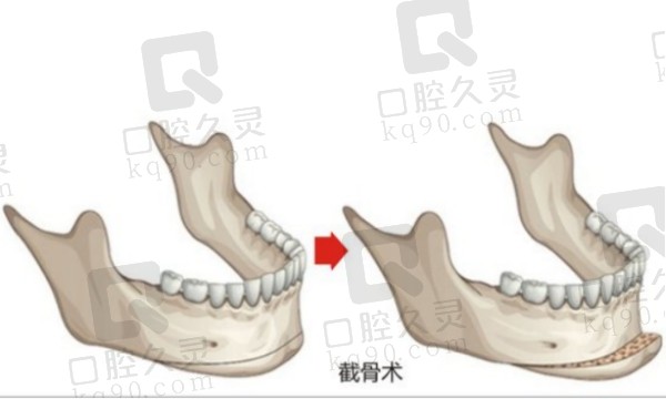 武汉江城整形外科医院做磨骨手术很不错