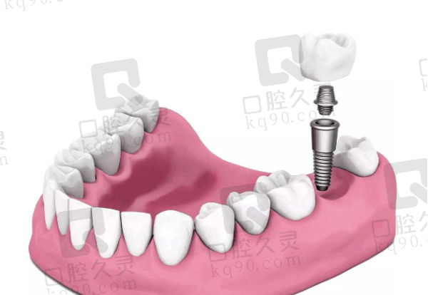 乌鲁木齐半口种植牙价格表