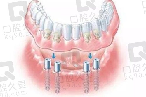 潍坊华贝口腔医院全口种植牙