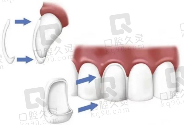 上海雅悦齿科牙齿贴面怎么样