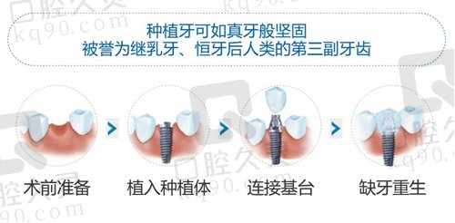 上海丽泽口腔医院种植牙过程