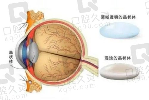 九江爱尔眼科医院白内障诊疗