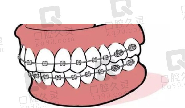 拔牙矫正会让拥挤的牙齿更自然