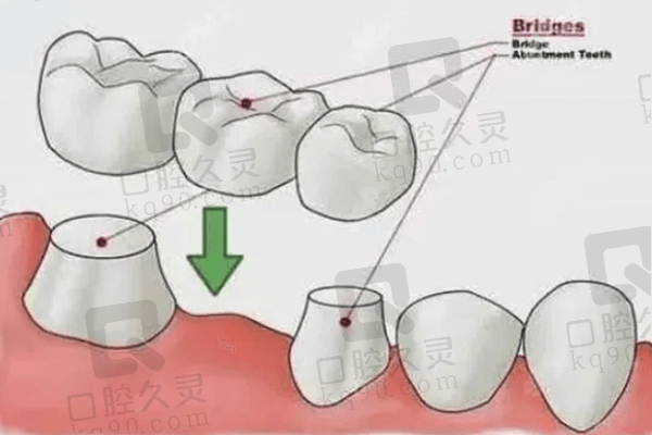 爱尔创全瓷牙的技术优势有哪些？