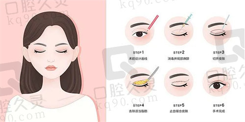 深圳美莱做眼睛怎么样？