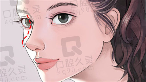深圳美莱做鼻子怎么样？