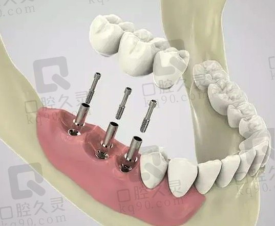 无锡惠山德厚口腔半口数字化种植牙好不好
