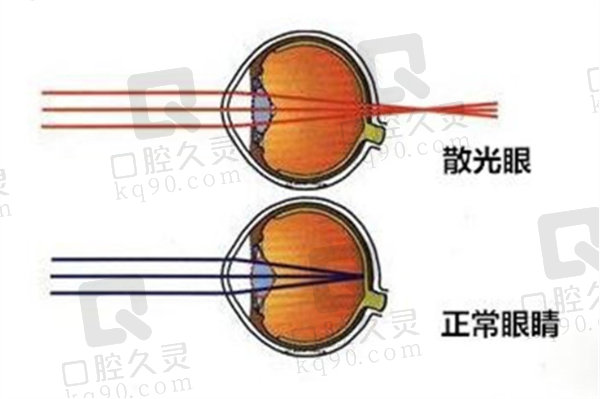 散光可以矫正过来吗