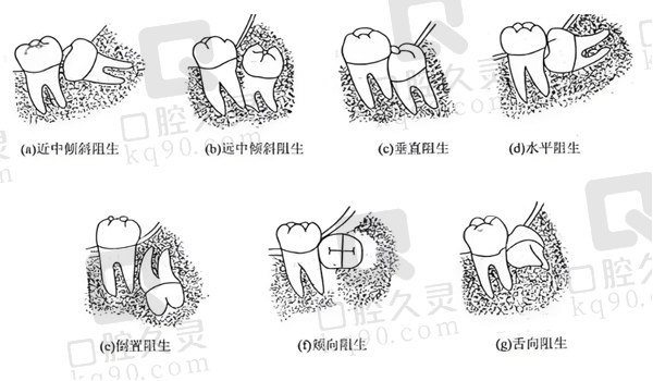 不同阻生牙的位置