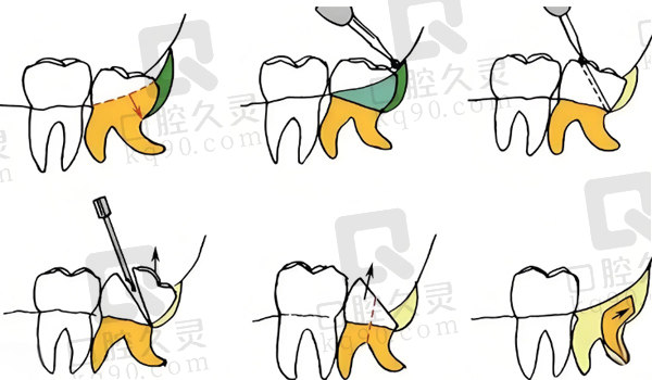 拔牙流程