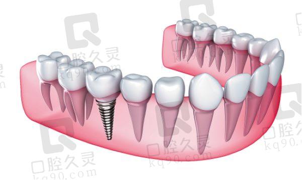 十堰从兵口腔医院百康特种植牙怎么样