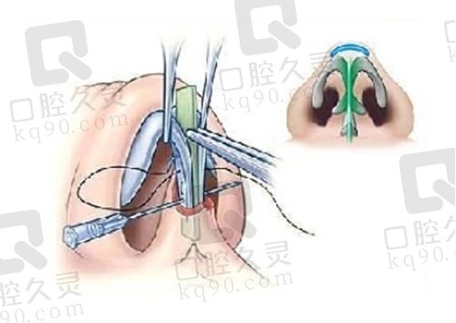 杭州艺星徐利刚医生做鼻子怎么样？