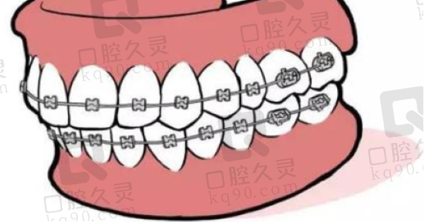 抚州南大口腔金属固定矫正多少钱