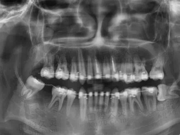 潍坊阳光口腔牙齿矫正真实病例分享