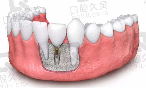 东莞天使口腔种植牙价格表