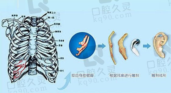 赵绛波医生肋软骨直埋法耳再造