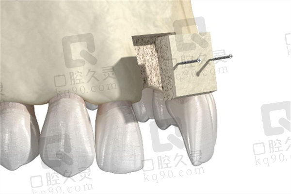 牙齿植骨是什么材料？