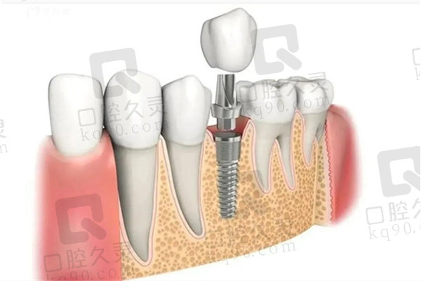 牙齿植骨是什么材料？