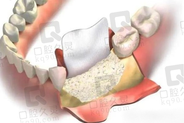 牙齿植骨是什么材料？