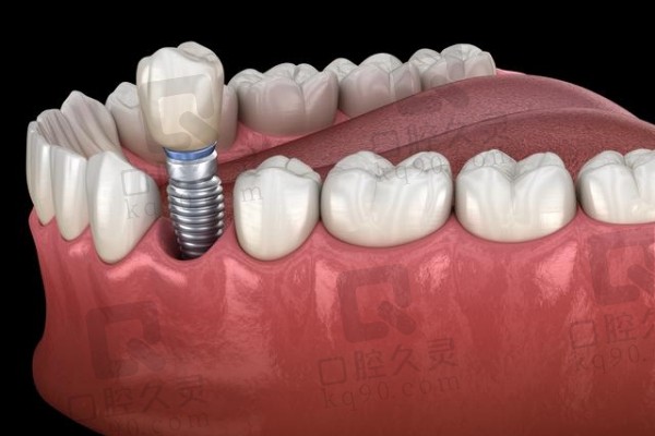 酒泉生达口腔医院种植牙价格