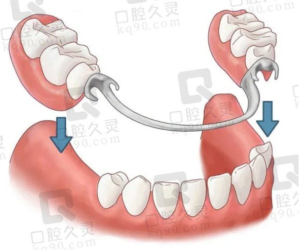 全口活动牙的优势是什么