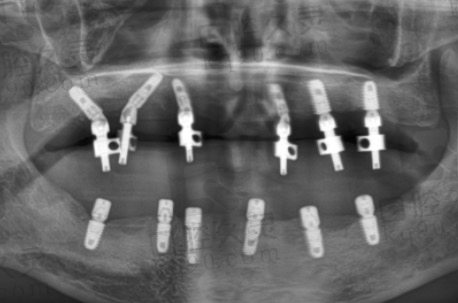 娄底爱牙邦口腔医院做全口种植牙三个月后