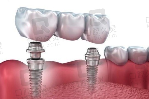 种植牙单颗牙冠好还是连体好？
