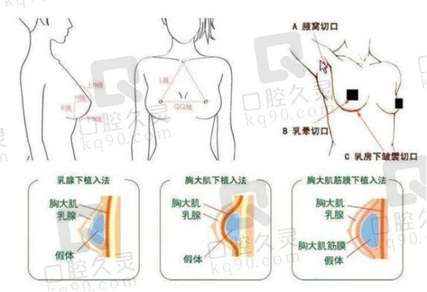 林沸腾隆胸是双平面技术吗