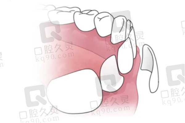 为什么牙齿美白选全瓷贴面好呢