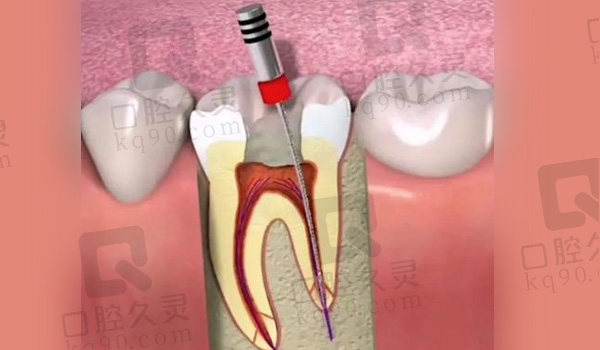 进行根管治疗