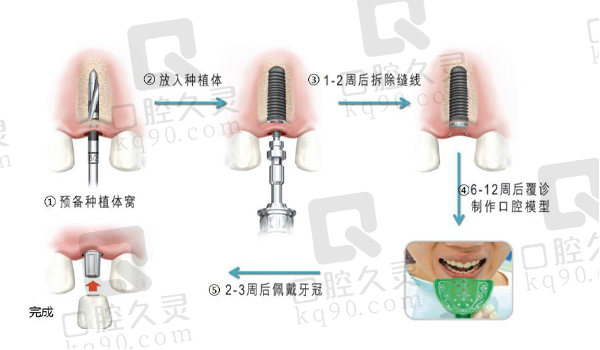 种植牙步骤图