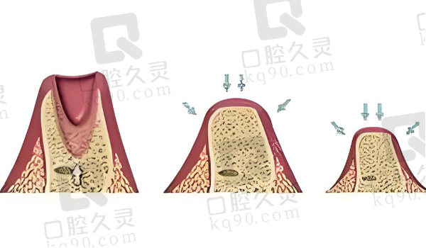 牙槽骨骨质不足造成的脱落