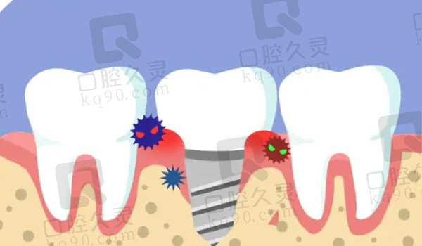 种植牙部位感染造成的植体脱落
