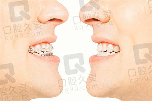 曹州口腔矫正牙齿价格表