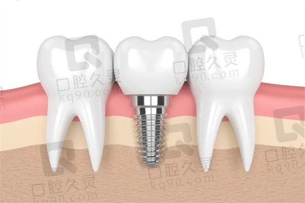 烤瓷牙和种植牙的区别